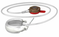 Gastric Banding