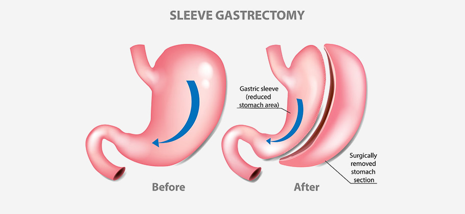 Sleeve Gastrectomy